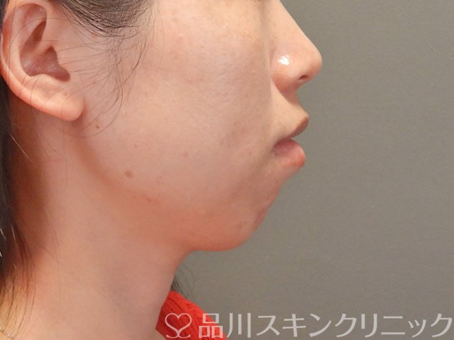 症例NO.75063のBEFORE写真