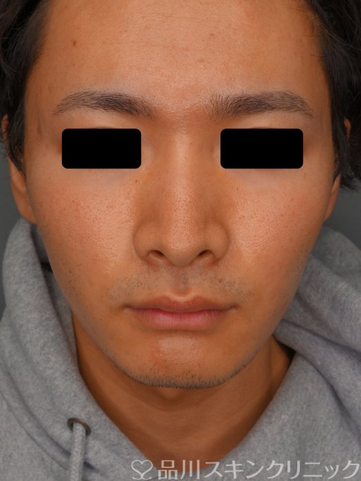 症例NO.73585のAFTER写真