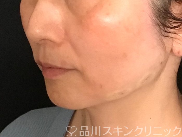 症例NO.65507のAFTER写真