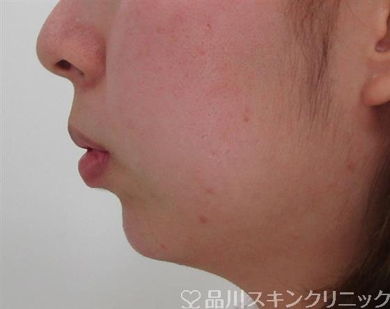 症例NO.34789のAFTER写真