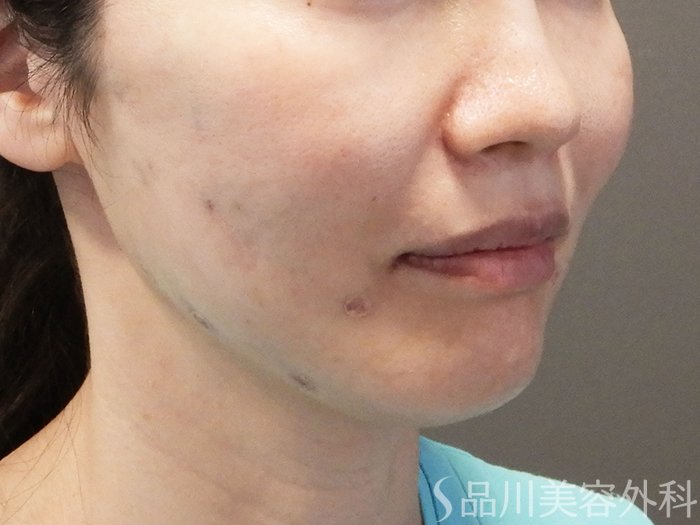 症例NO.69175のAFTER写真