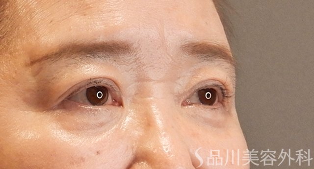 症例NO.75353のAFTER写真