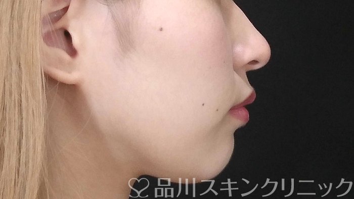 症例NO.71640のBEFORE写真