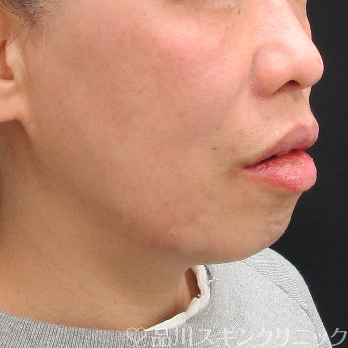 症例NO.73981のAFTER写真