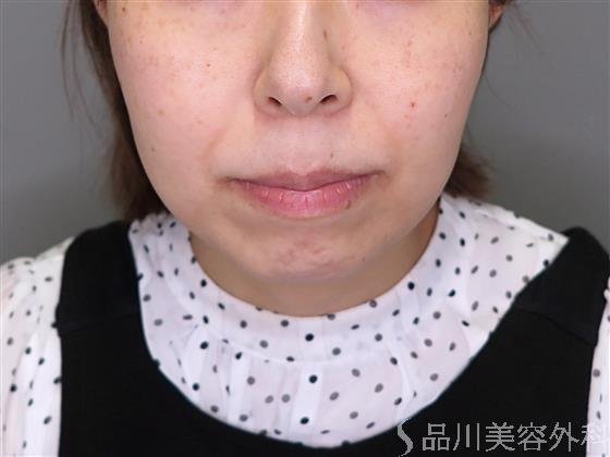 症例NO.48150のBEFORE写真