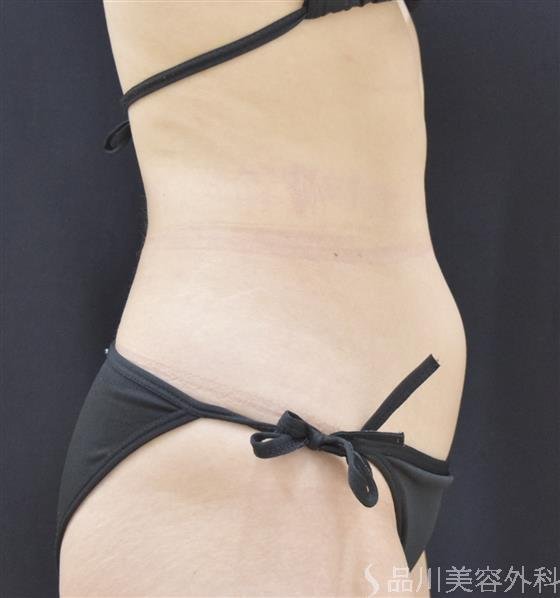 症例NO.47834のAFTER写真