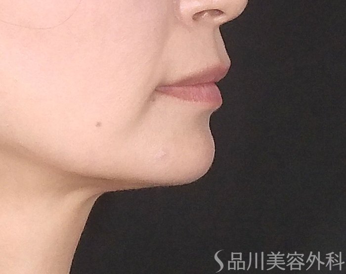 症例NO.65465のBEFORE写真