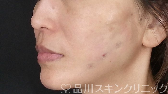 症例NO.71287のAFTER写真