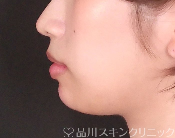 症例NO.70135のAFTER写真