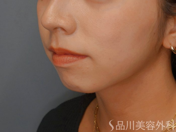 症例NO.74064のBEFORE写真