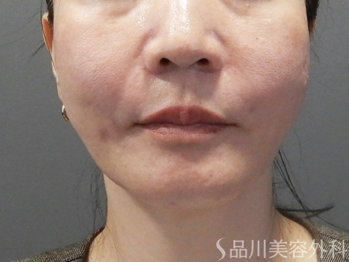 症例NO.72530のAFTER写真