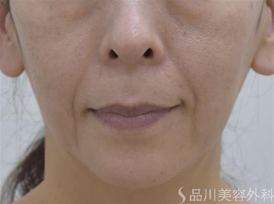 症例NO.48021のBEFORE写真