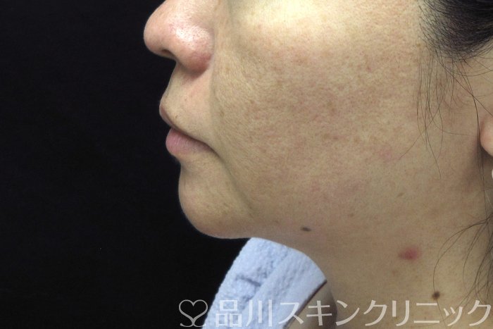 症例NO.74498のBEFORE写真