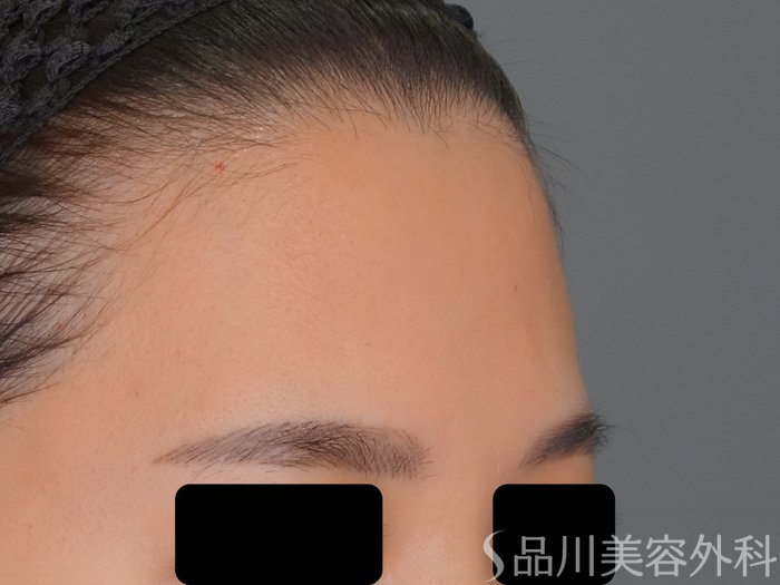 症例NO.69696のBEFORE写真