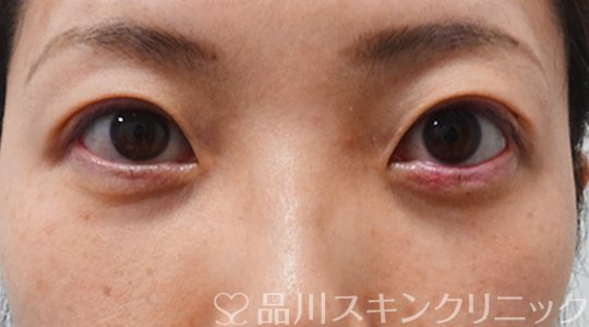 症例NO.70672のAFTER写真