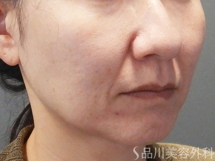症例NO.73937のBEFORE写真