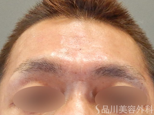 症例NO.75248のAFTER写真