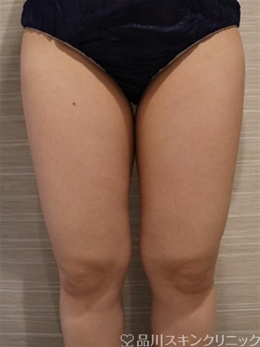 症例NO.42247のAFTER写真