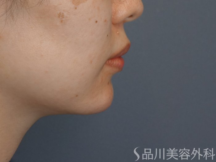 症例NO.71272のAFTER写真