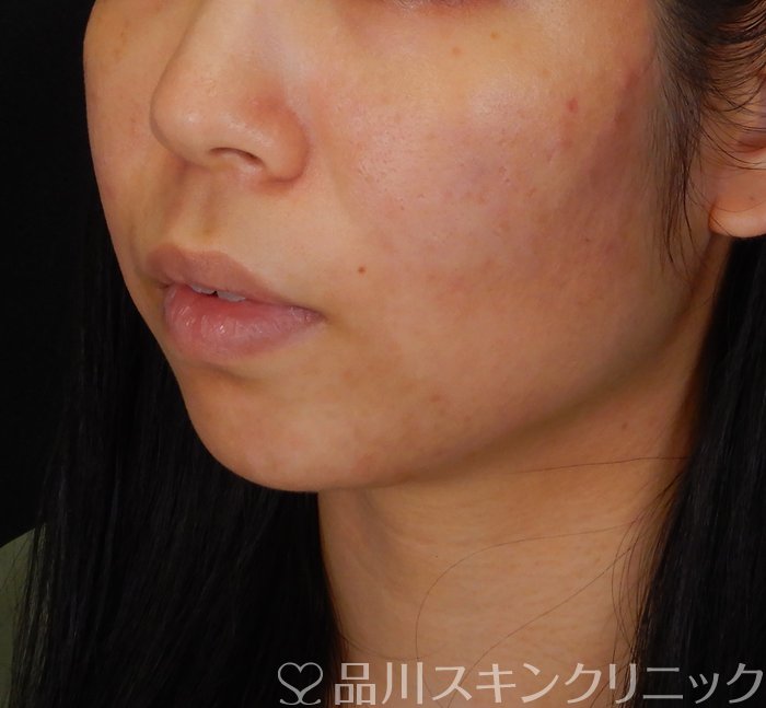 症例NO.67482のBEFORE写真