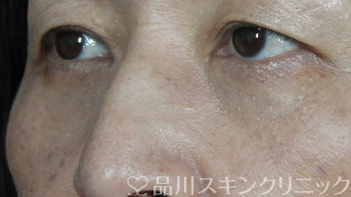症例NO.71730のAFTER写真