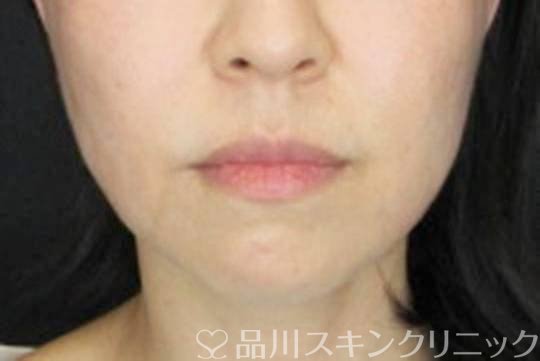 症例NO.72622のAFTER写真