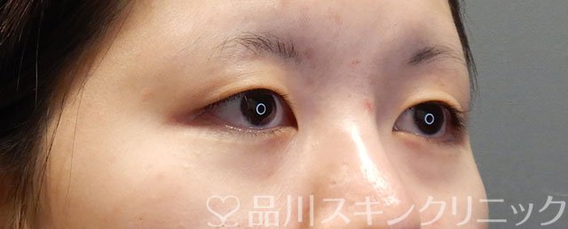 症例NO.74494のBEFORE写真