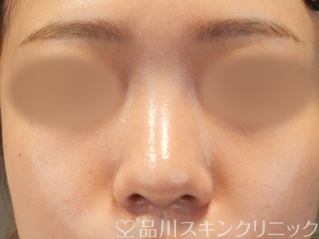 症例NO.65617のBEFORE写真