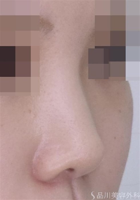 症例NO.50981のBEFORE写真