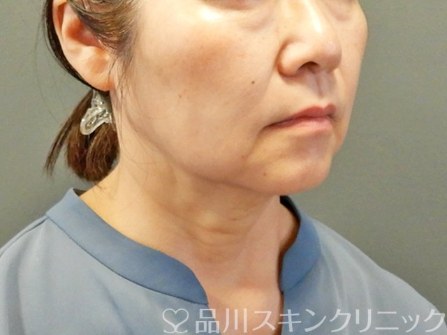 症例NO.67754のAFTER写真