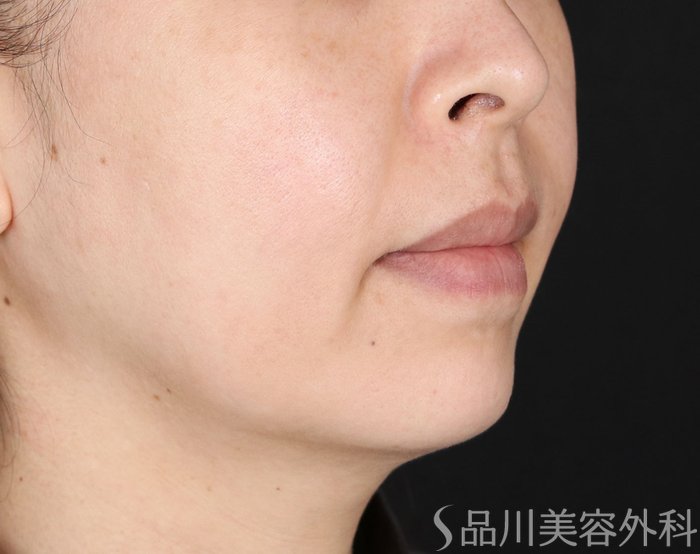 症例NO.71921のBEFORE写真