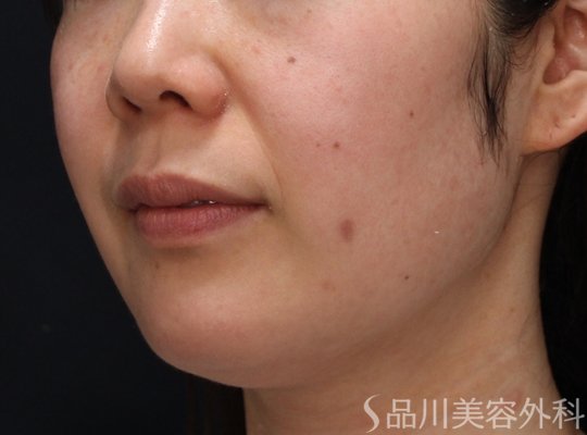 症例NO.74287のBEFORE写真