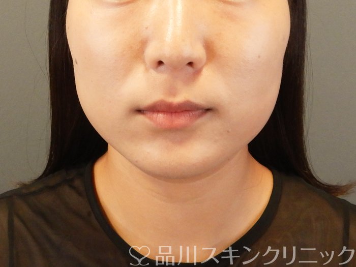 症例NO.66685のAFTER写真