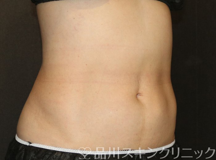 症例NO.71319のAFTER写真