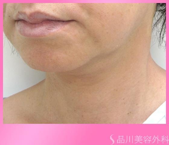 症例NO.1715のAFTER写真