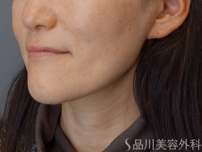 症例NO.72865のBEFORE写真