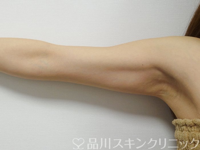 症例NO.74551のAFTER写真