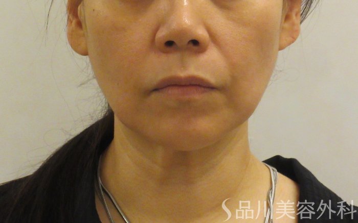 症例NO.71527のBEFORE写真