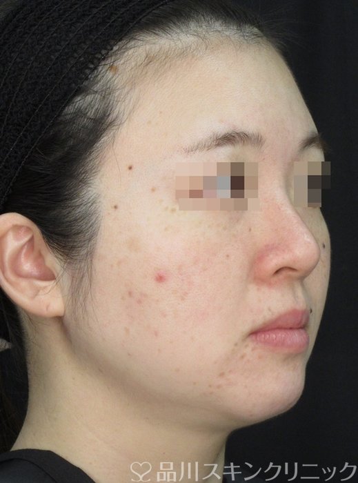 症例NO.72175のAFTER写真