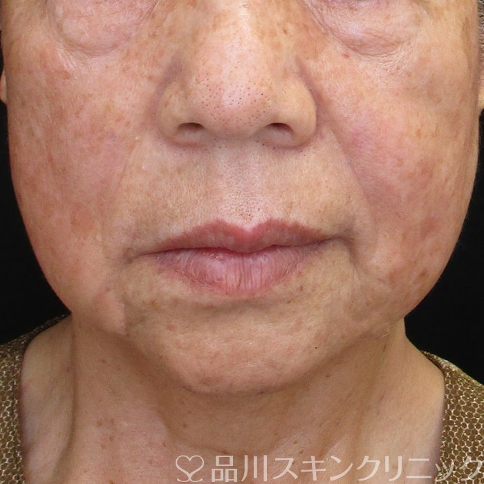 症例NO.72887のAFTER写真