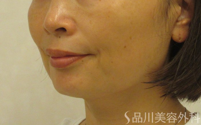 症例NO.71567のBEFORE写真