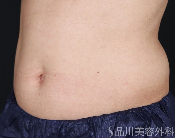 症例NO.72564のBEFORE写真