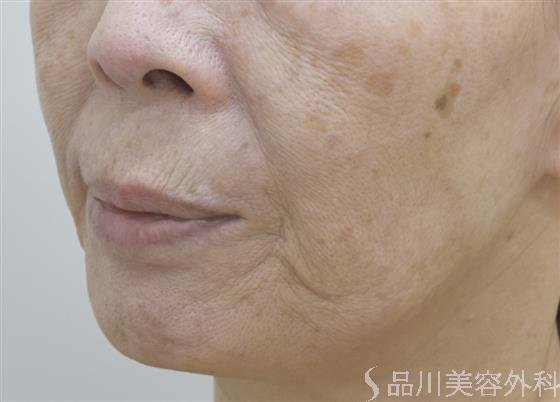 症例NO.45357のBEFORE写真