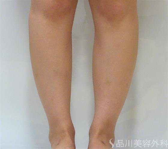 症例NO.37760のAFTER写真