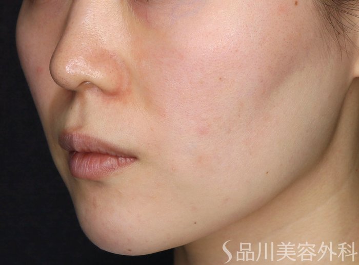 症例NO.69617のBEFORE写真