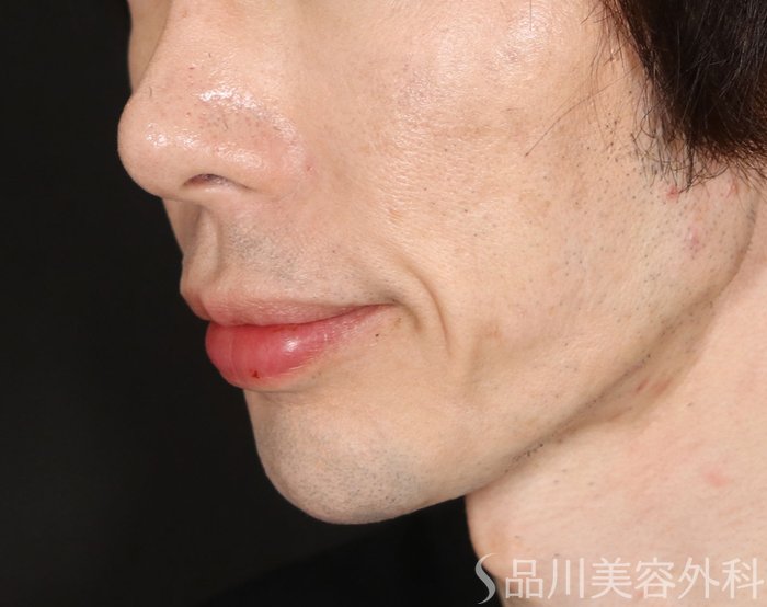 症例NO.74327のBEFORE写真