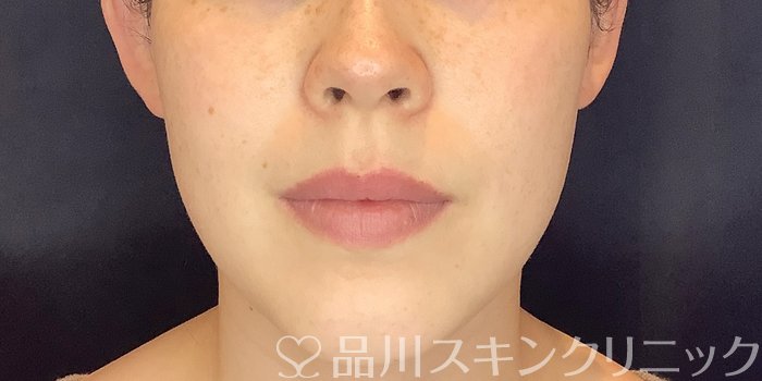 症例NO.69555のAFTER写真