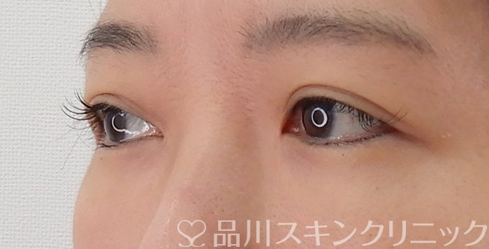 症例NO.62183のAFTER写真