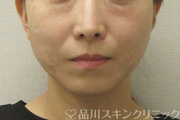 症例NO.73965のAFTER写真