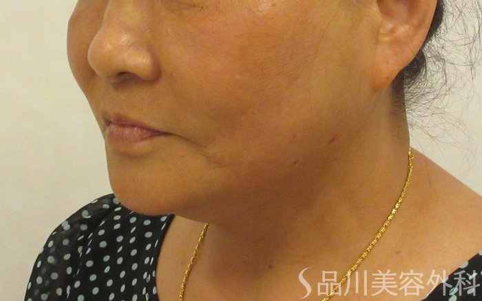 症例NO.72131のAFTER写真